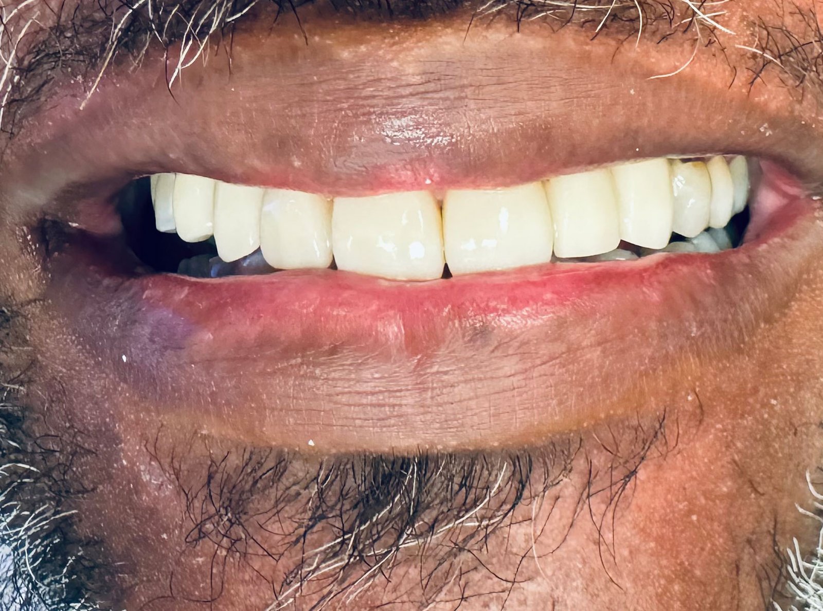 After treatment