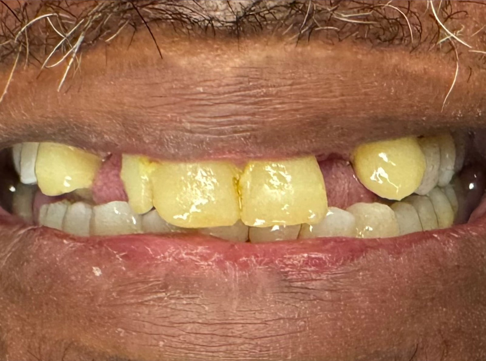 Before treatment