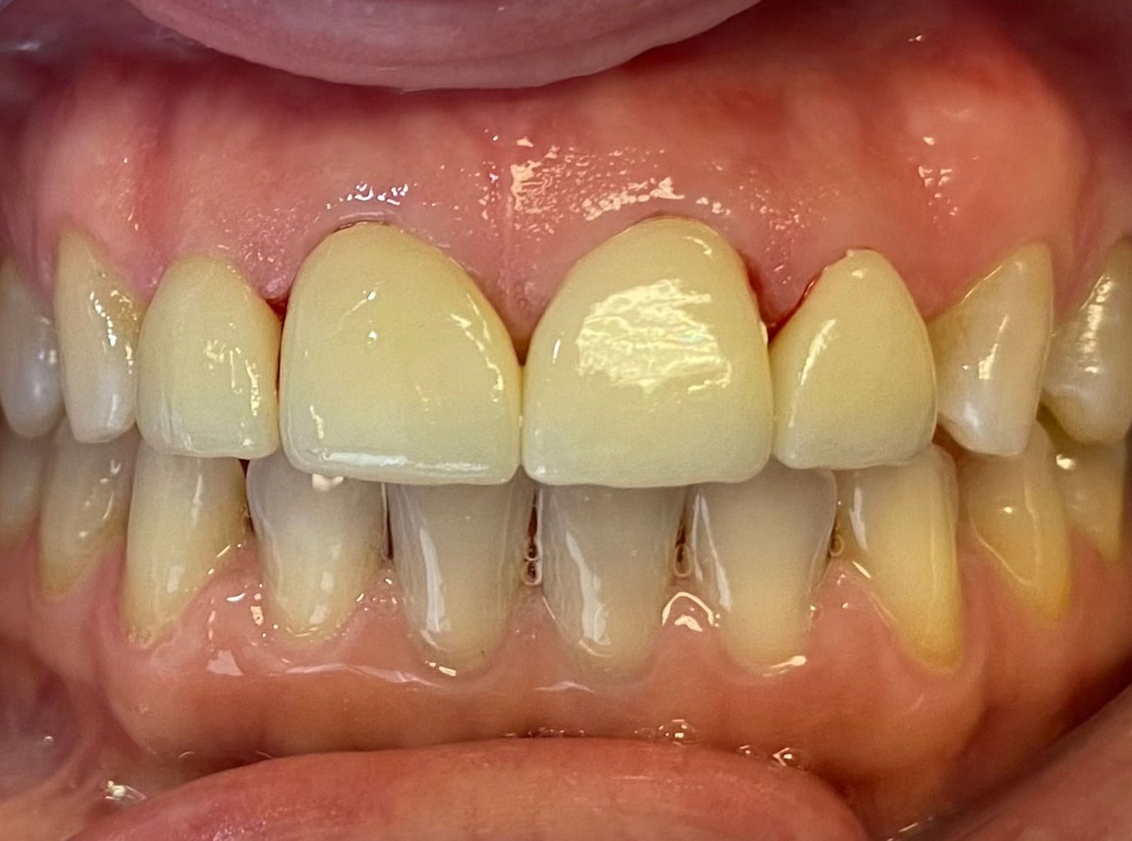 After treatment