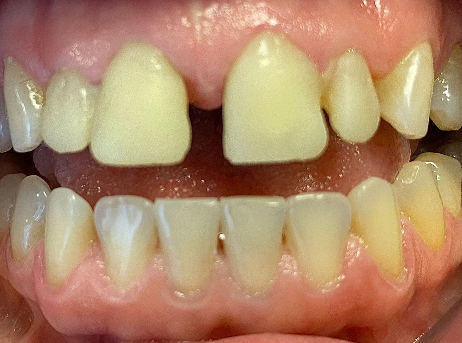 Before treatment