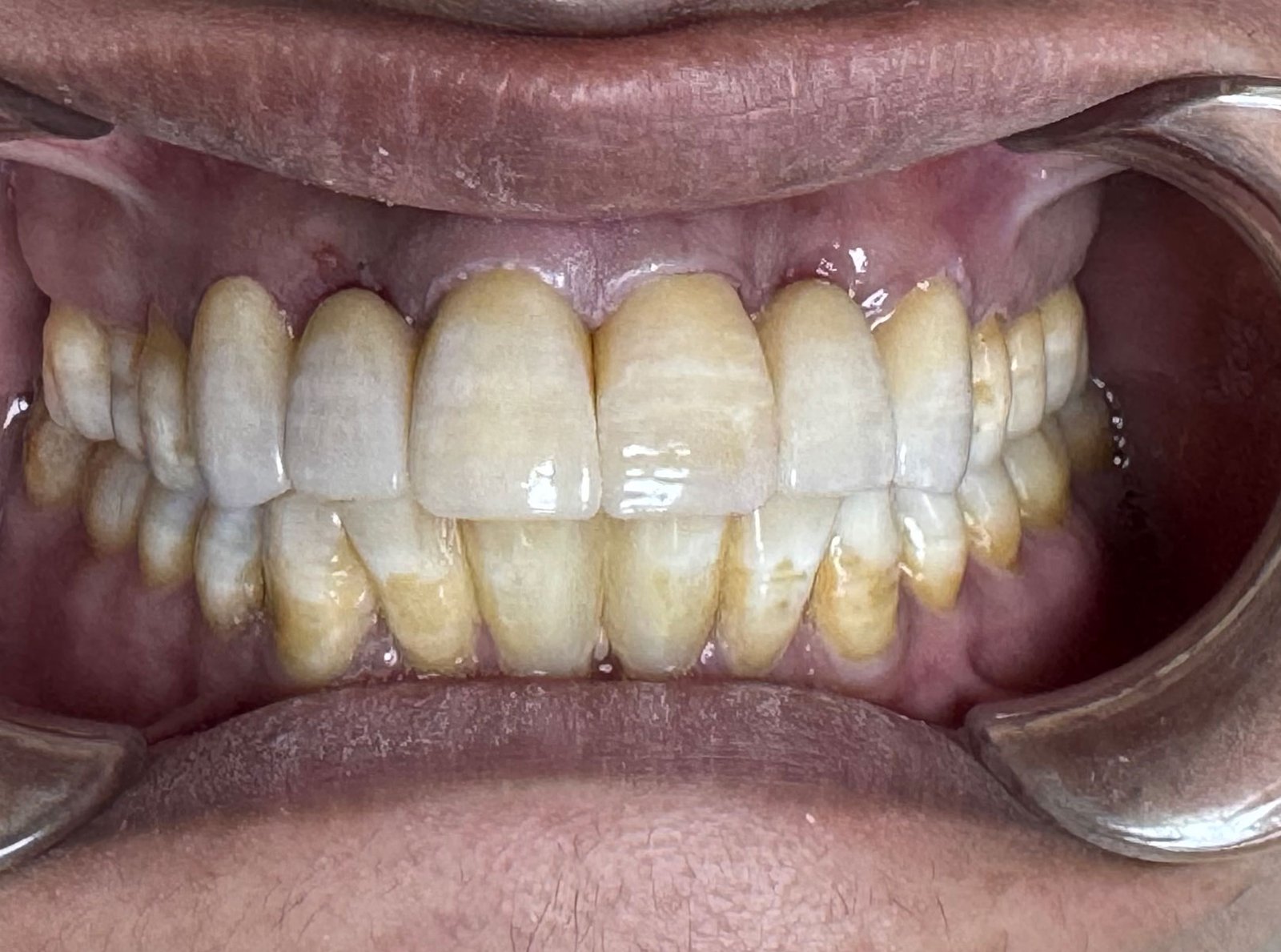 After treatment