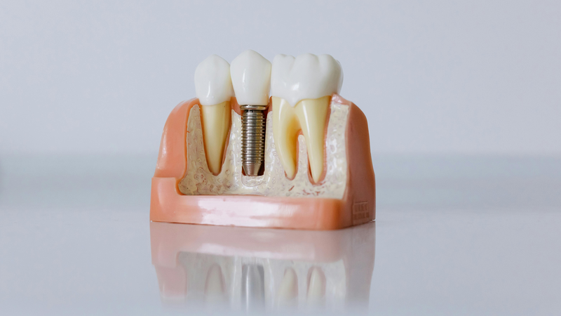 dental implants vs dentures