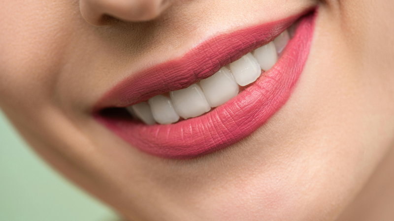 dental veneers cost in Pakistan